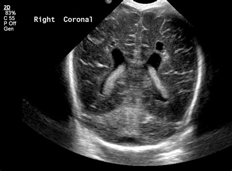 pvl ultrasound images
